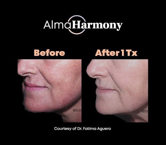 Experten weltweit vertrauen auf Alma Harmony Experten weltweit vertrauen auf Alma Harmony